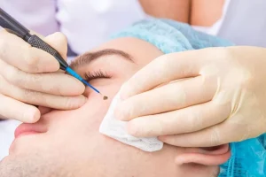 הסרת נקודת חן מהפנים באמצעות לייזר – טיפול אסתטי מקצועי