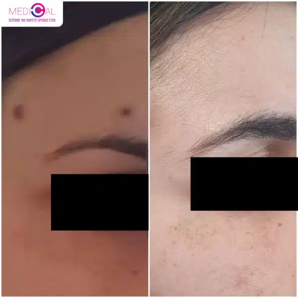 לפני ואחרי הורדת נקודת חן קטנה מעל הגבה – הסרה בלייזר, תוצאה נקייה ללא תפרים | Medical-C