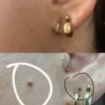 הסרת שומה בפנים לפני ואחרי