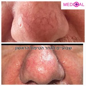 הסרת נימים בלייזר מחיר