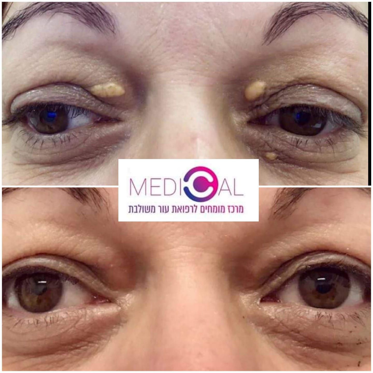 תמונה לפני ואחרי טיפול בלייזר להסרת קסנטלזמה בעפעפיים – Medical C