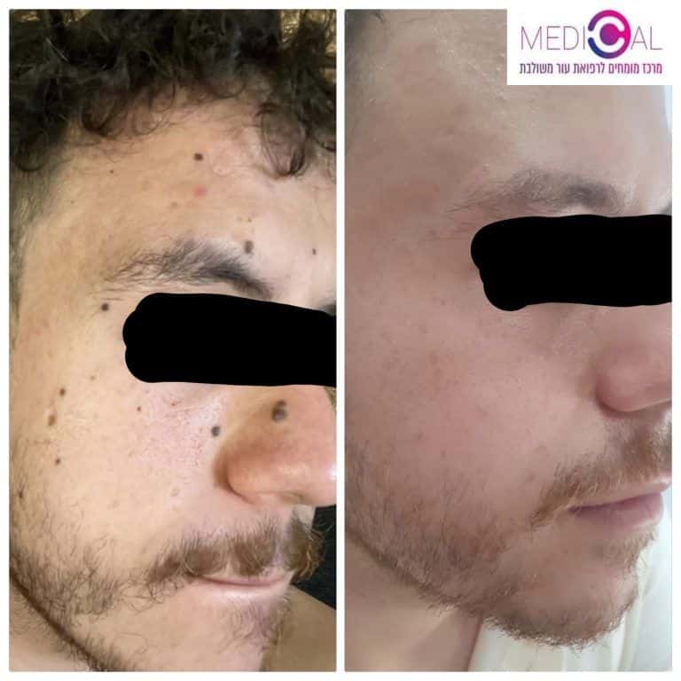 לפני ואחרי הסרת נקודות חן מהפנים בלייזר רפואי