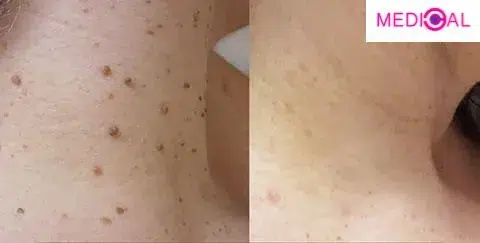 תמונה של לפני ואחרי הסרת סרחי עור בלייזר במרפאת MEDICAL-C