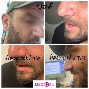 לפני ואחרי הסרת נקודת חן | שומה מאזור האף במדיקל סי