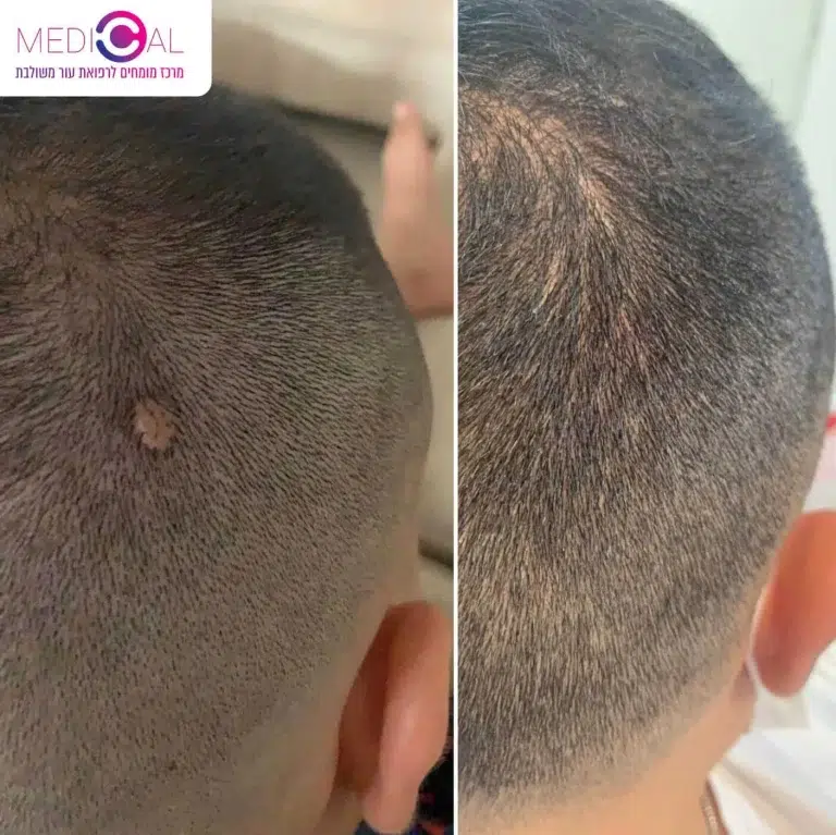 ציסטה בקרקפת לפני ואחרי טיפול להסרה במרפאת MEDICAL-C