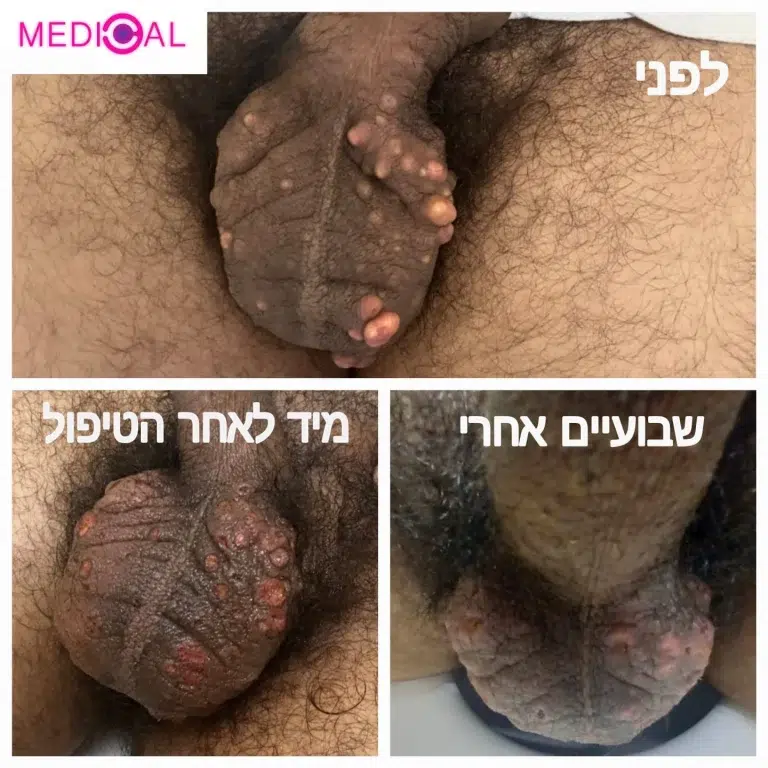 קלצינוזיס calcinosis cutis לפני ואחרי