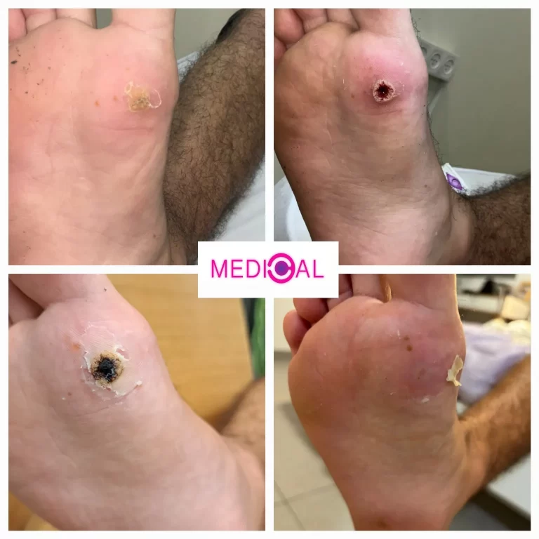 לפני ואחרי טיפול ביבלת בכף הרגל באמצעות לייזר – תוצאה אסתטית עם ריפוי מלא בקליניקת מדיקל C
