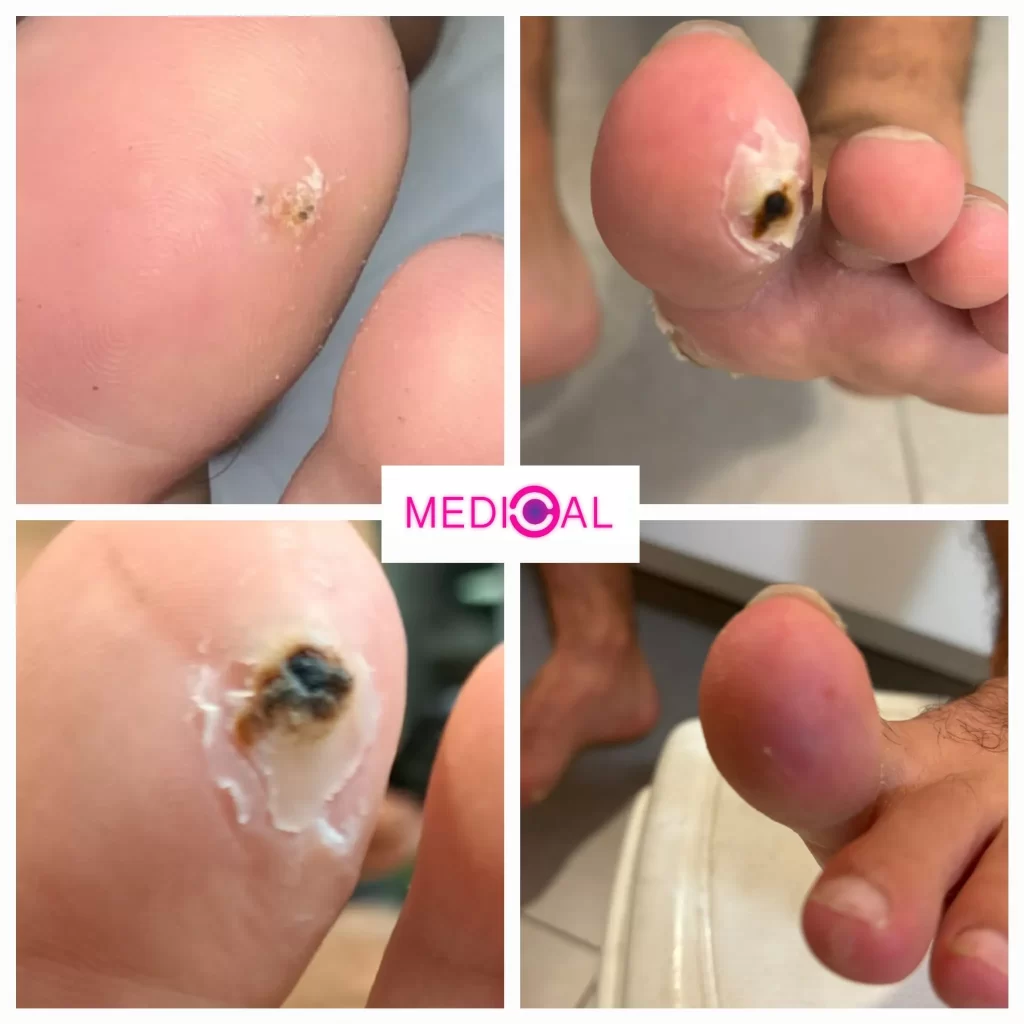לפני ואחרי טיפול ביבלת באצבע כף הרגל באמצעות לייזר – בקליניקת מדיקל C