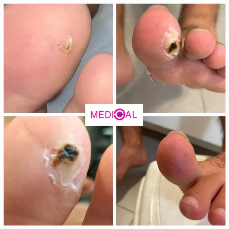 לפני ואחרי טיפול ביבלת באצבע כף הרגל באמצעות לייזר – בקליניקת מדיקל C