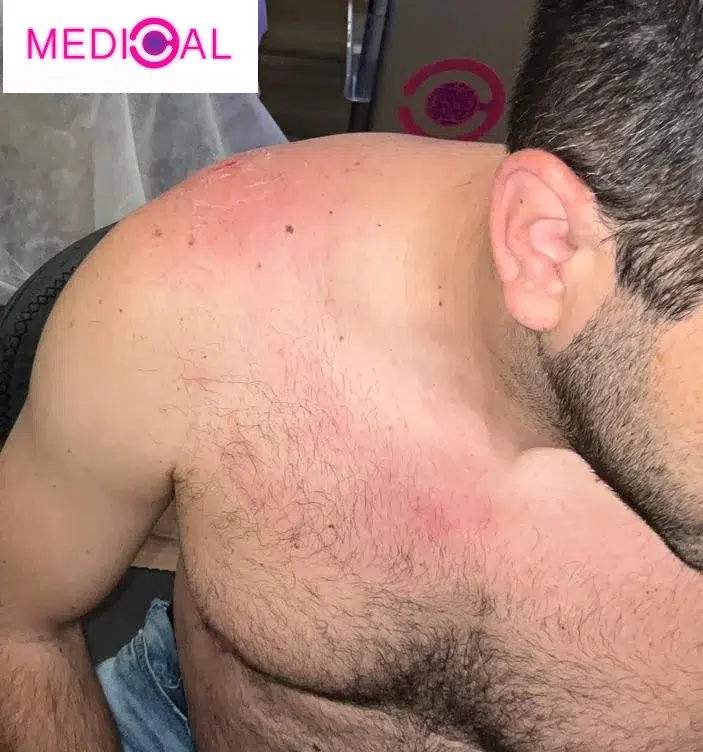 תוצאה לאחר הסרת ליפומה בכתף אצל גבר באמצעות לייזר בקליניקת Medical C