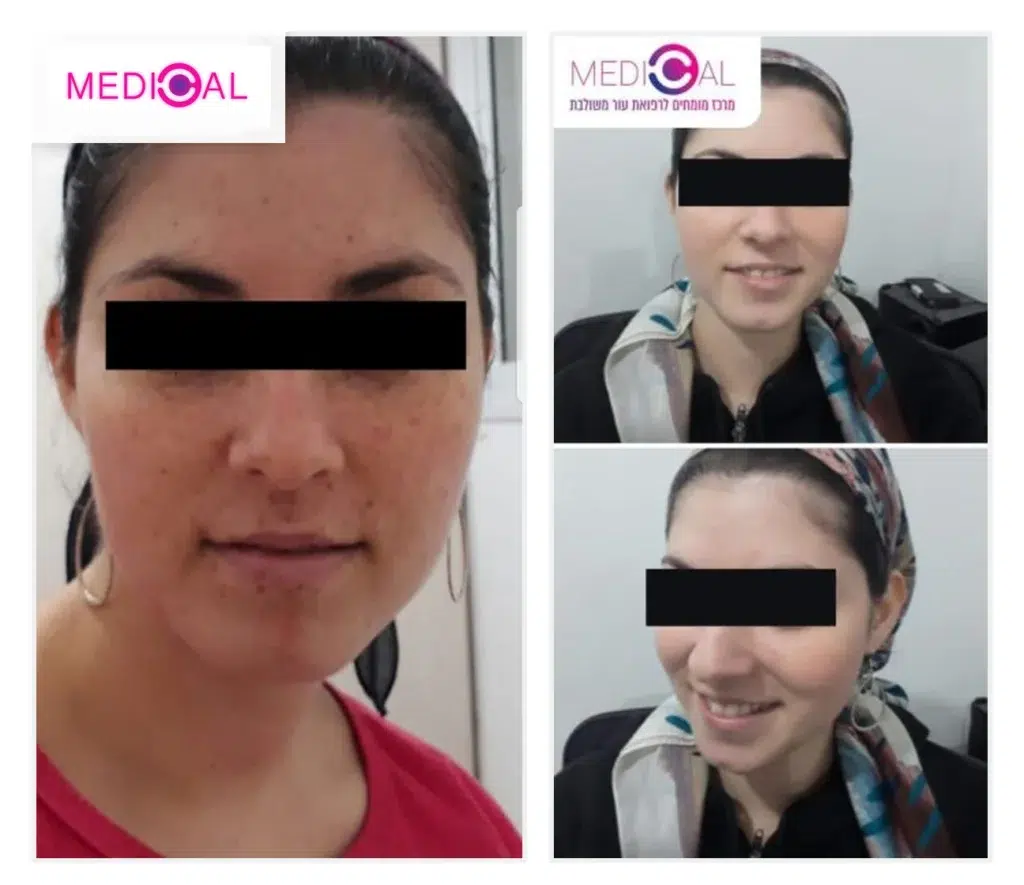 קולאז׳ לפני ואחרי של מטופלת עם נמשים שהובהרו לאחר טיפול לייזר – הסרת נמשים