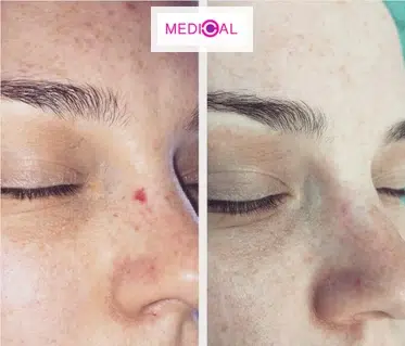 הסרת המנגיומות (Cherry Angioma) – תמונת לפני ואחרי של נקודות אדומות שהוסרו בעדינות