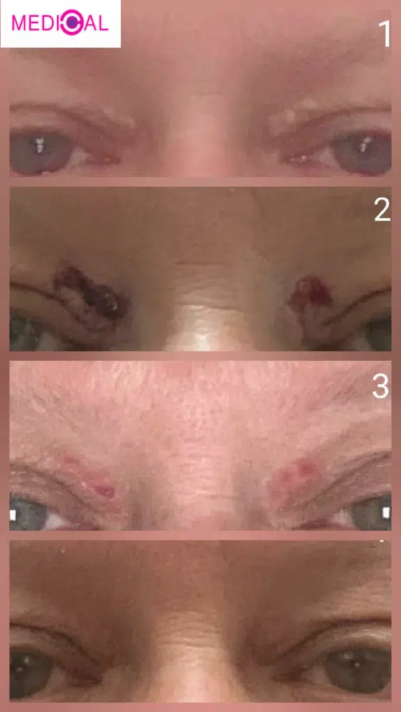 לפני ואחרי הסרת קסנטלזמה בעפעפיים – תוצאות טיפול מדויק ובטוח במרפאת Medical C