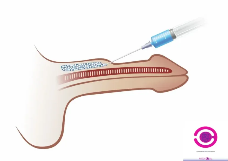 איור רפואי של עיבוי הפין בהזרקת חומרי מילוי מתחת לעור לצורך הגדלת היקף הפין ללא ניתוח במרפאת Medical C.