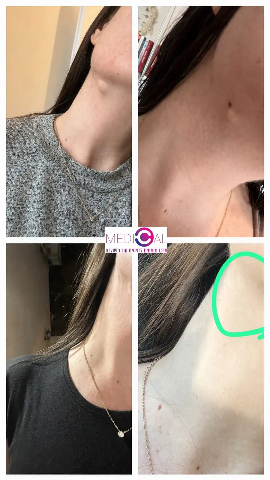 ציסטה בצוואר לפני ואחרי הסרה במרפאת Medical C