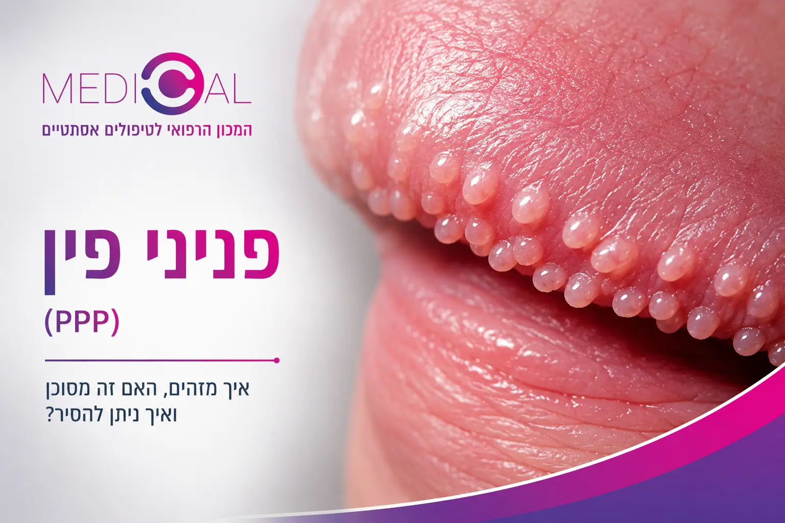 פניני פין (PPP) – פפולות פניניות סביב עטרת הפין